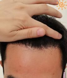 -大麦微针植发丨全国连锁