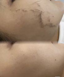 -薇兰专业脱毛连锁机构