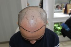 -大麦微针植发丨全国连锁