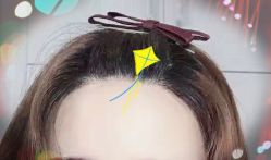 -大麦微针植发全国连锁