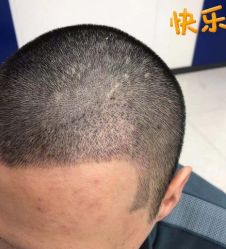 -大麦微针植发丨全国连锁