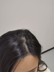 -大麦微针植发全国连锁