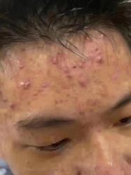 -苗方清颜专业祛痘连锁机构