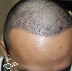 -大麦微针植发丨全国连锁