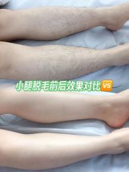 -薇兰专业脱毛连锁机构