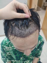 -大麦微针植发丨全国连锁