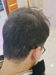 -大麦微针植发丨全国连锁