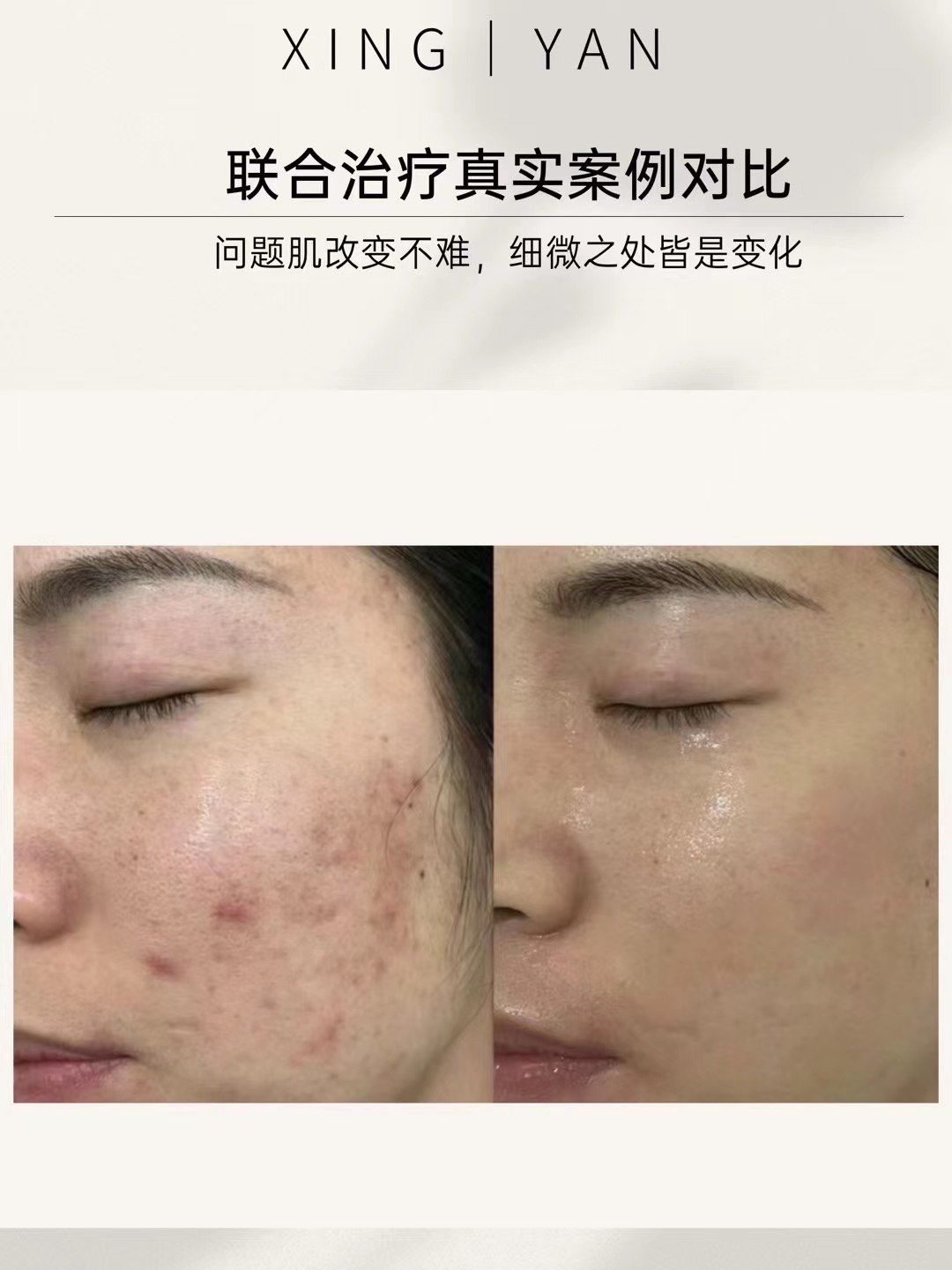 洞而囊肿会100%形成痘坑
所以一旦长痘