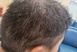 -碧莲盛·不剃发植发