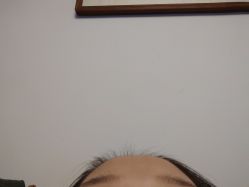 -黑奥秘脱发白发中心