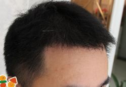 -大麦微针植发丨全国连锁