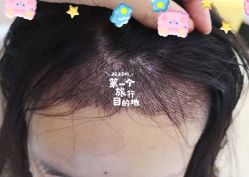 -大麦微针植发全国连锁