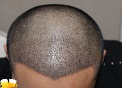 -大麦微针植发丨全国连锁