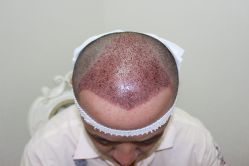 点击看大图 -大麦微针植发丨全国连锁