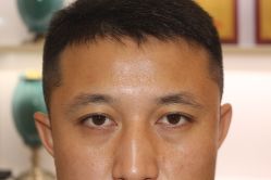 -大麦微针植发丨全国连锁