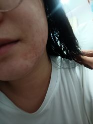 -悟空祛痘·诺奖技术专业店