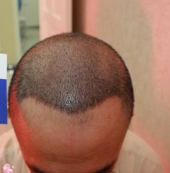 -大麦微针植发丨全国连锁