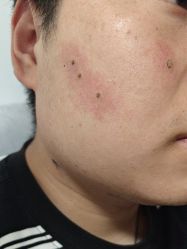 -北京美痣堂古方祛痣斑疣瘊