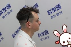 点击看大图 -大麦微针植发丨全国连锁