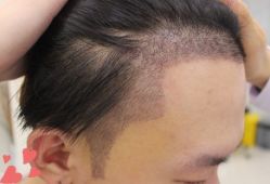 -大麦微针植发丨全国连锁