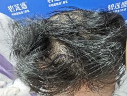 -碧莲盛不剃发植发