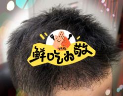 -大麦微针植发全国连锁