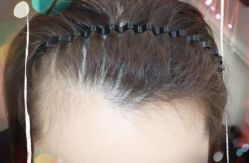 -大麦微针植发全国连锁