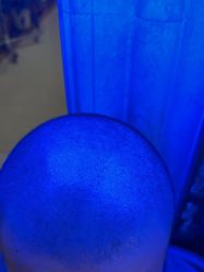 -碧莲盛·不剃发植发