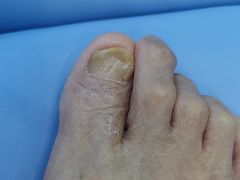 -Andrew指甲专科灰指甲·甲沟炎矫正·3D步态矫形鞋垫定制(浦三路店)