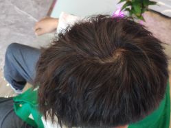 -碧莲盛·不剃发植发