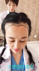 点击看大图 -大麦微针植发丨全国连锁