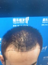 体验前-雍禾植发全国连锁