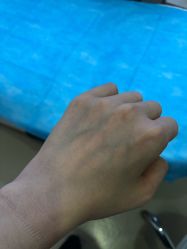 体验前-嘉和医学脱毛中心