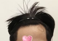 -大麦微针植发全国连锁
