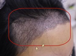 -大麦微针植发全国连锁