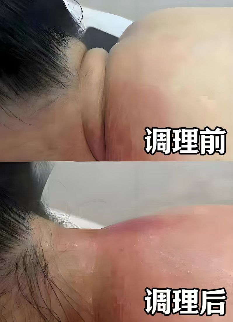 脖颈纹,富贵包调理一次后前后对比图!