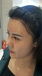 -大麦微针植发丨全国连锁