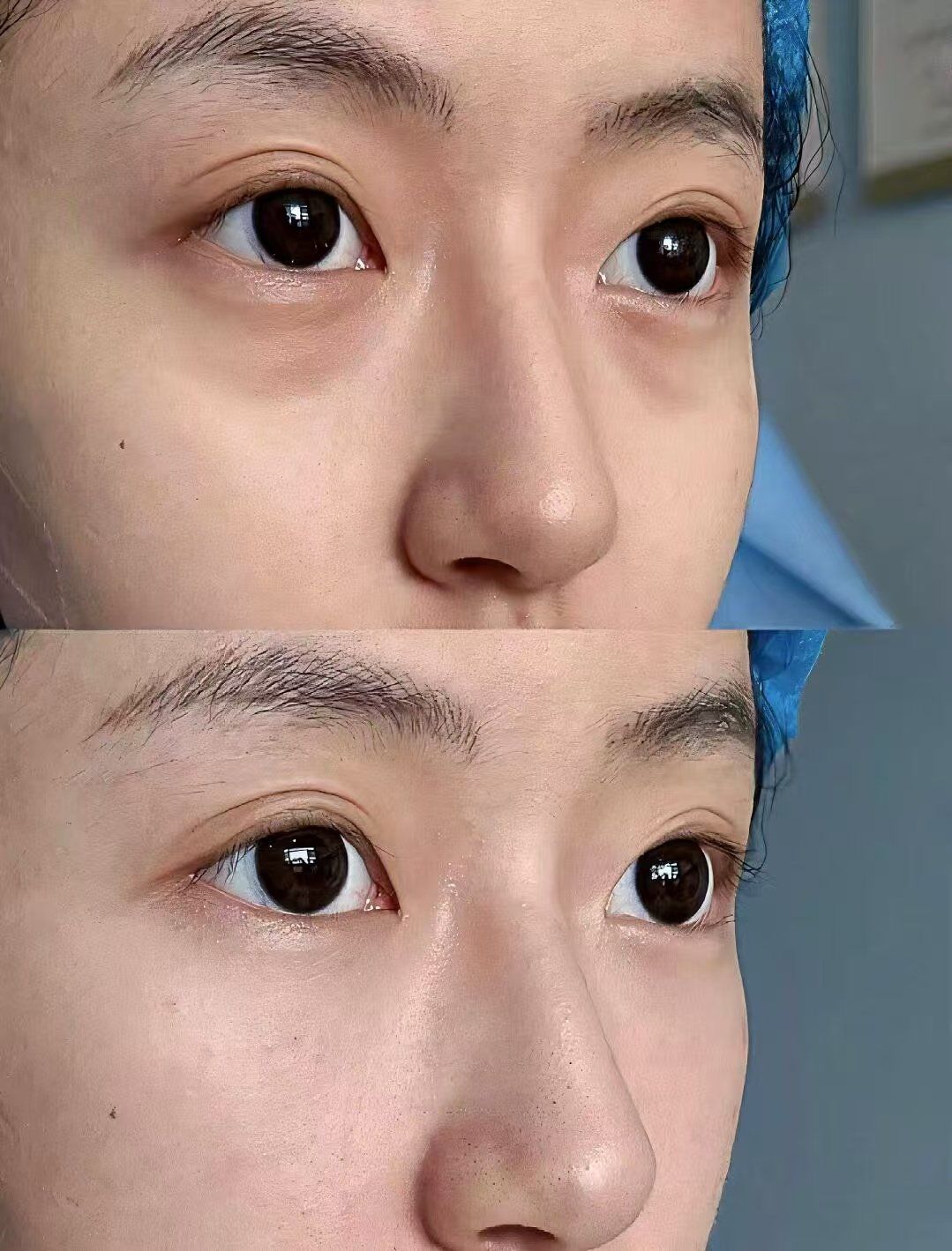 人生初体验✔️黑眼圈泪沟终于莫得啦