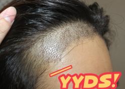 -大麦微针植发丨全国连锁