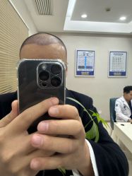 -大麦微针植发丨全国连锁