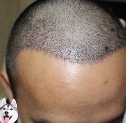 -大麦微针植发丨全国连锁