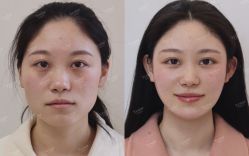 点击看大图 体验后-Yestar宁波艺星整形医院