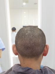 -大麦微针植发全国连锁