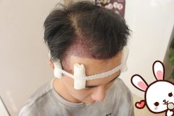 -大麦微针植发丨全国连锁