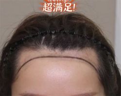 -大麦微针植发全国连锁