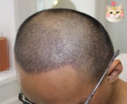 -大麦微针植发丨全国连锁