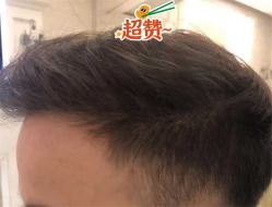 -大麦微针植发全国连锁