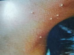 -痣清宫祛斑祛痣连锁店