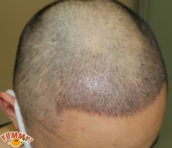 -大麦微针植发丨全国连锁