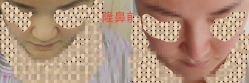 体验后-东莞壹加壹整形美容医院